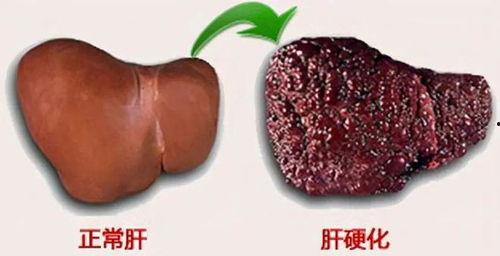 肝硬化可以吃嫩瓜,肝硬化患者适宜食用的嫩瓜养生之道